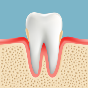 歯周病治療　P1　軽度