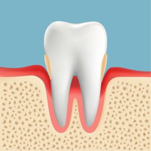 歯周病治療　P2　中度