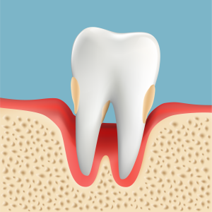 歯周病治療　P3　重度