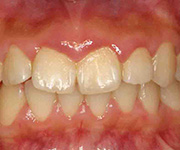 初期の歯周炎