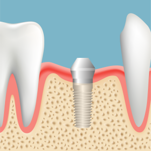 インプラントが骨と結合したら、再度歯茎を開き、インプラントの頭を出します。