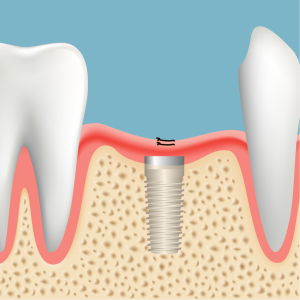 つるみ矯正歯科のインプラント治療