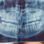レントゲンによる口腔疾患の説明