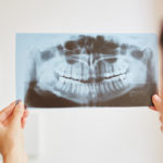 矯正治療の抜歯と非抜歯ケース