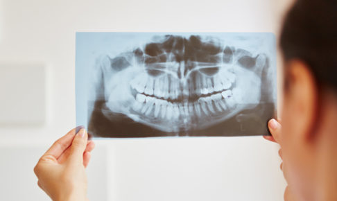 矯正治療の抜歯と非抜歯ケース