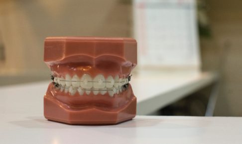 歯列矯正中の痛み_つくばのつるみ矯正歯科